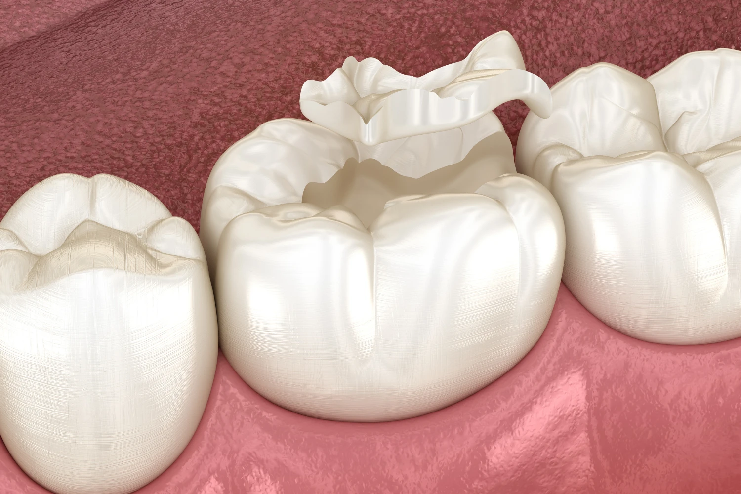 Damaged Tooth Repair in Devon - Image 01