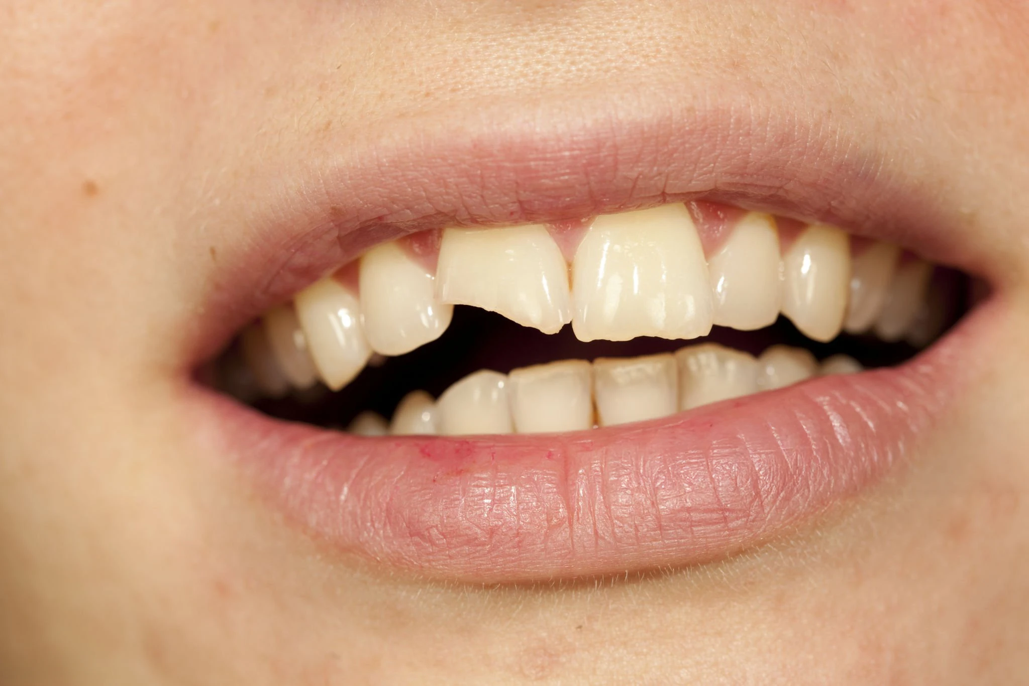 Dental Repair Options at Devon Dental Centre