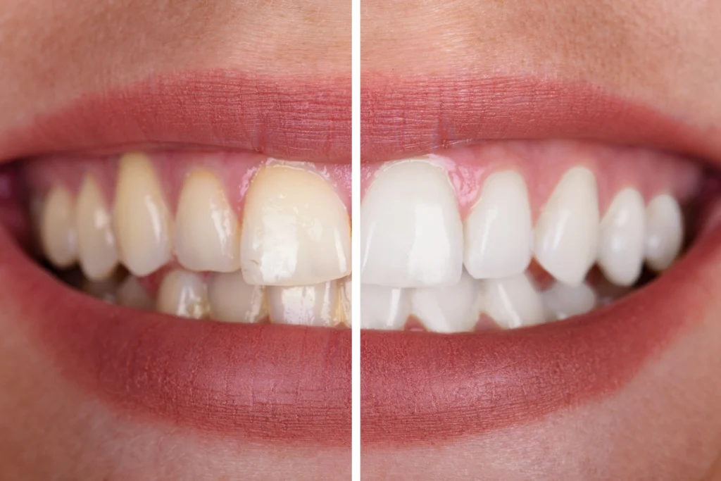 Teeth Whitening in Devon What to Expect Before, During, and After - Image
